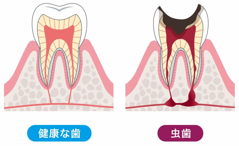 むし歯を治療する基準について